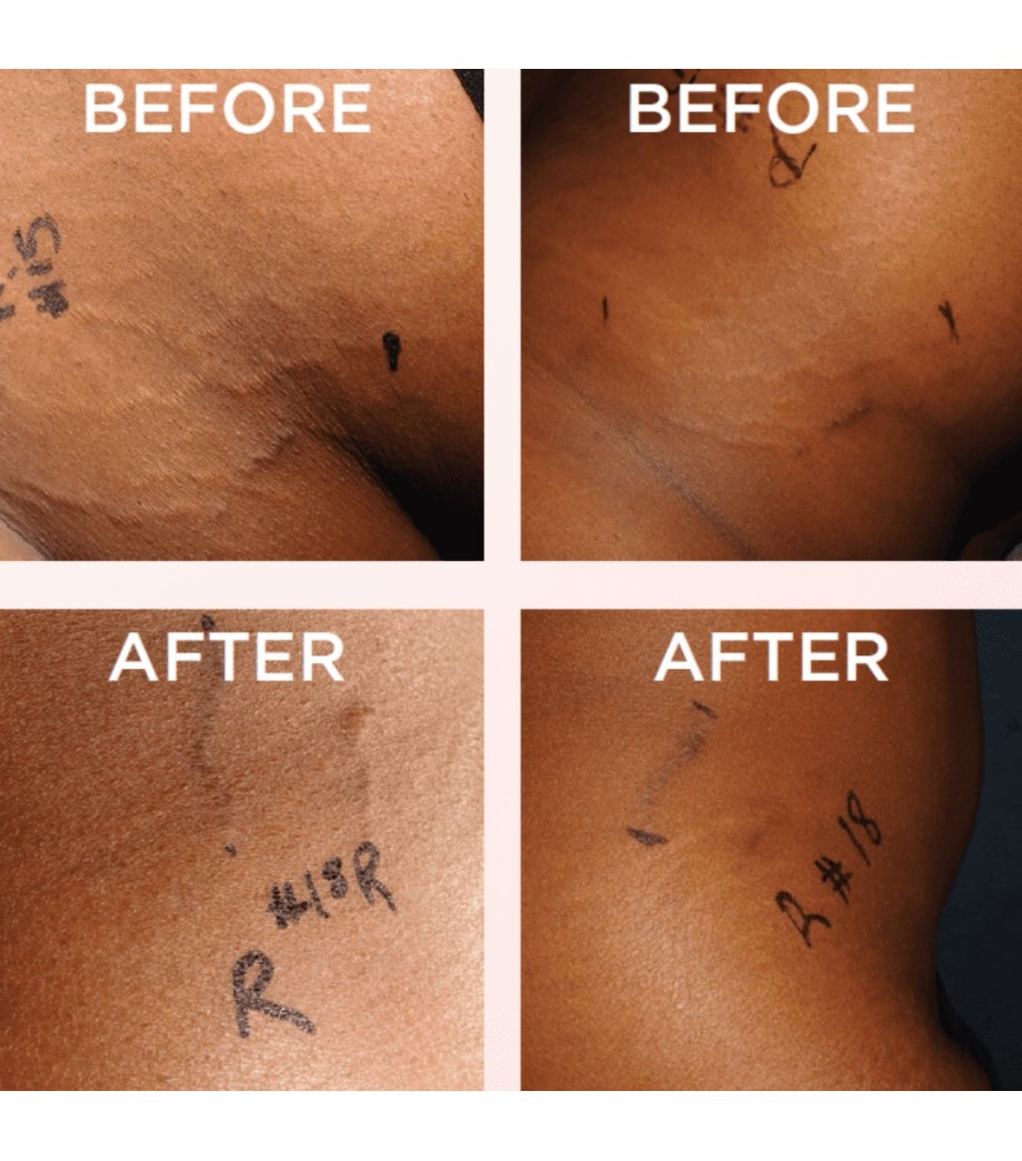 Scars and stretch marks