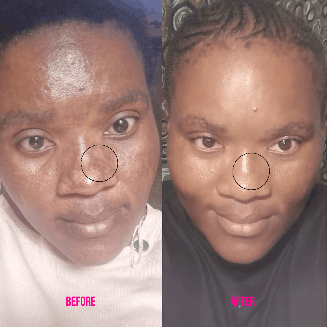 Basix Blemish & Dark Spot Correcting Set - Before and after of hyperpigmentation and blemishes