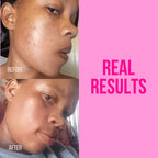 Before and after results showing visible improvement in hyperpigmentation and blemishes with the Basix Brightening Trio