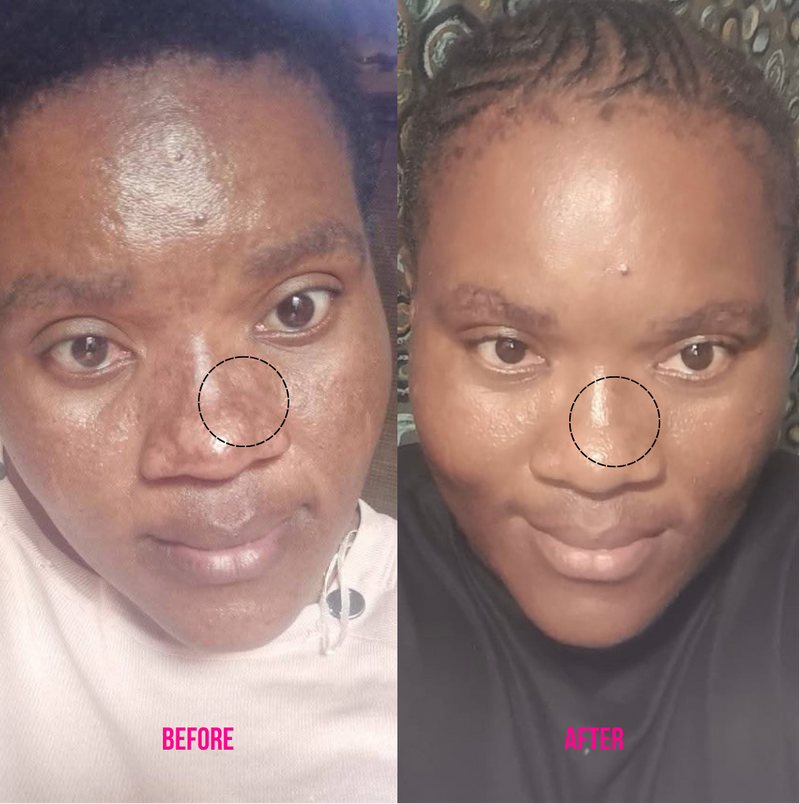 Before and after comparison of a person's face with a circle highlighting a specific area to show blemish correction.