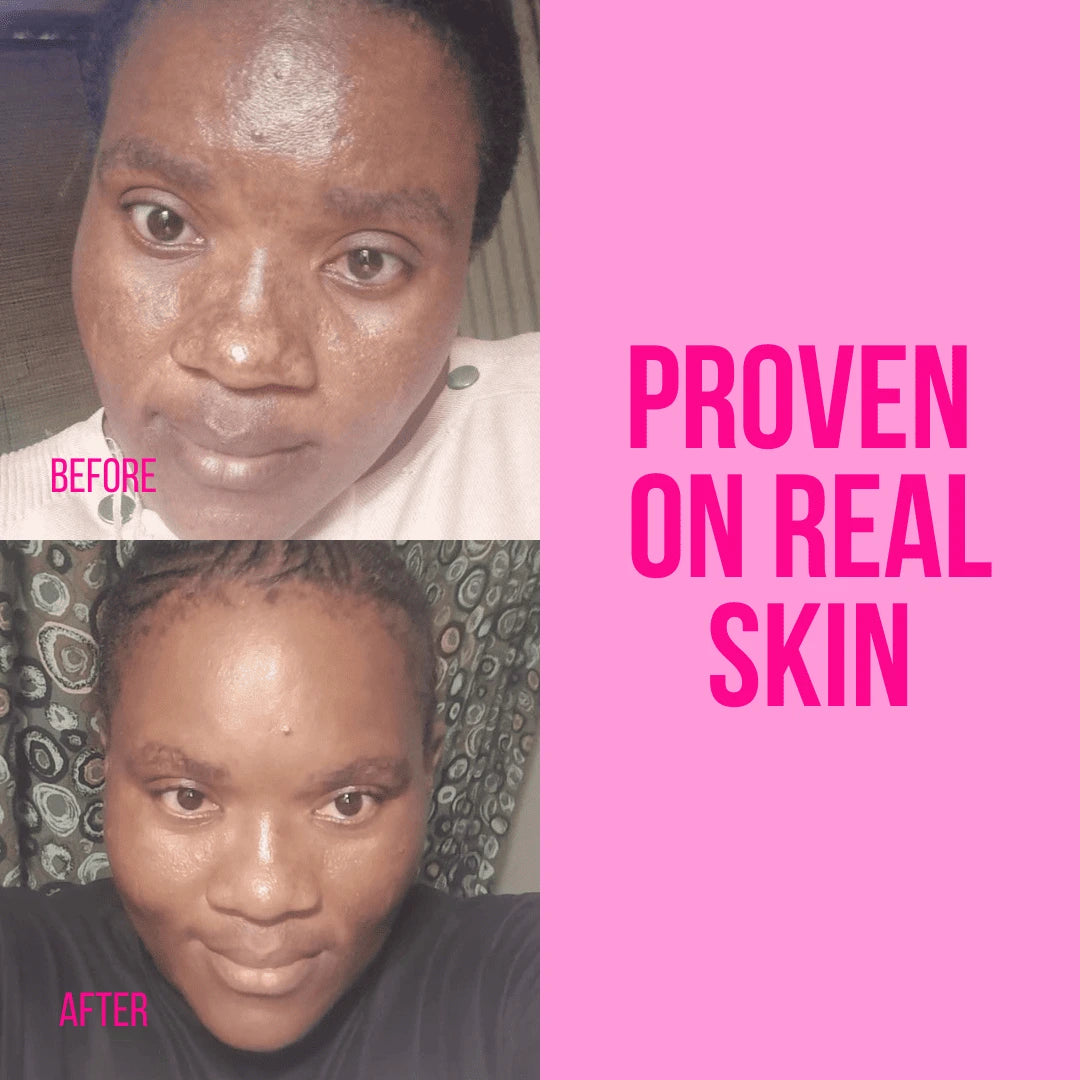 Blemish & Dark Spot Correcting Set - Face