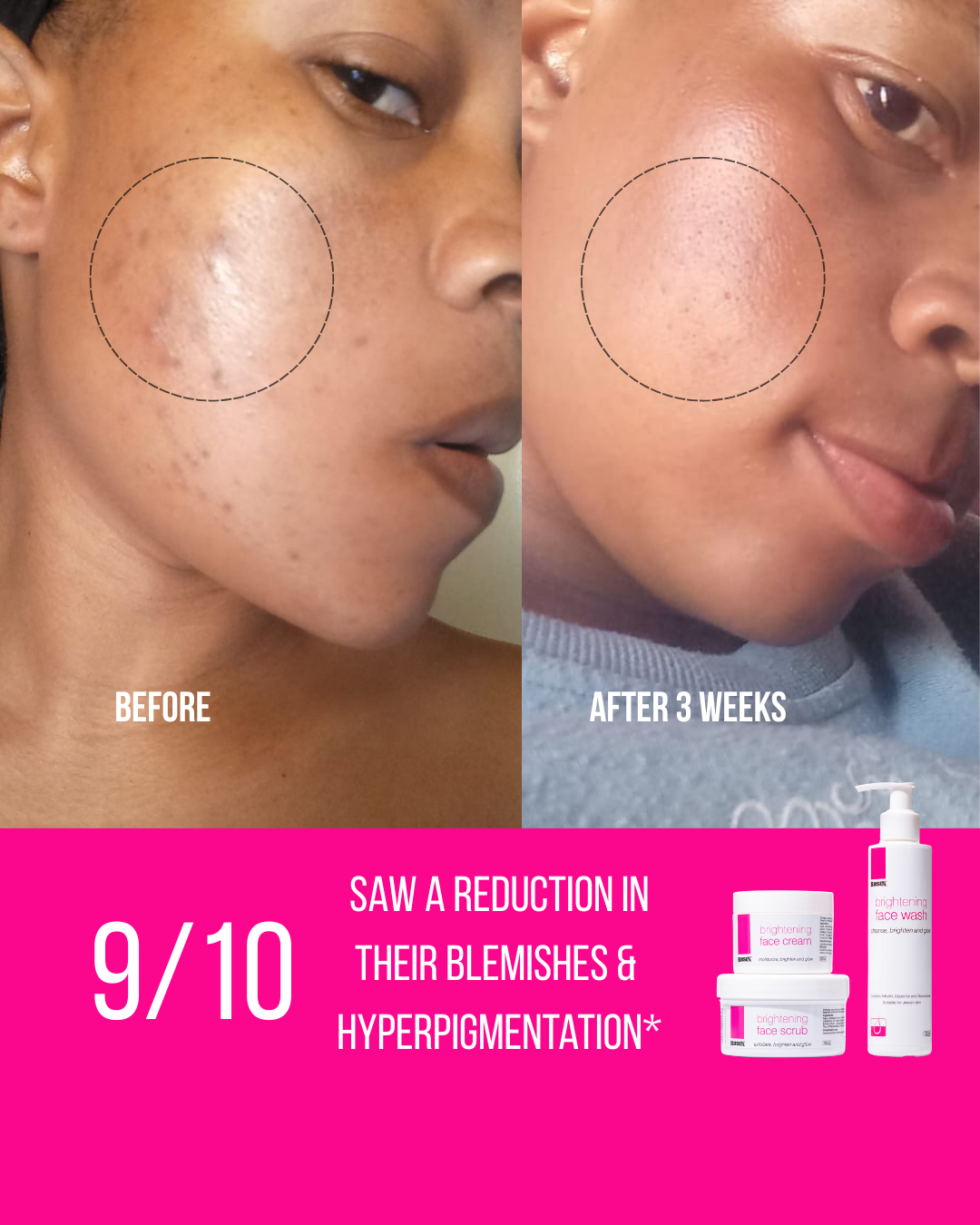 Blemish & Dark Spot Correcting Set - Face