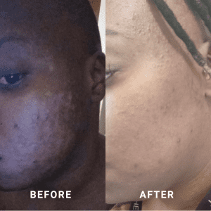 Heal acne and pimples with Basix Skin Repair Cream