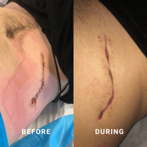 Appendectomy surgery customer before and after with Basix skin repair cream