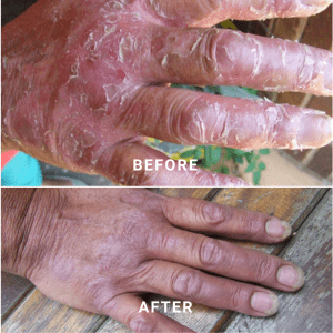 Heal your Eczema with Basix XM, before and after review