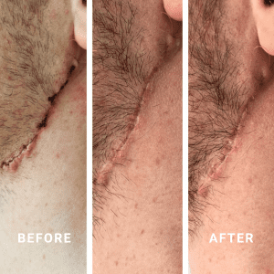 Heal your surgical incisions and cuts with Basix Skin Repair Cream.