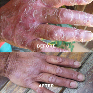 ECZEMA BEFORE AND AFTER